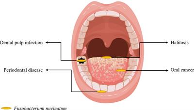 More Than Just a Periodontal Pathogen –the Research Progress on Fusobacterium nucleatum